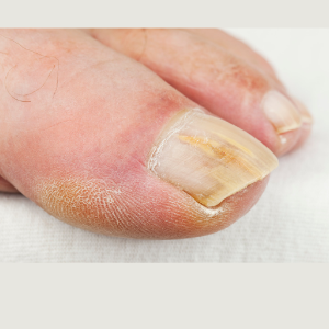 How Fungal Nail Infections Affect Nail Shape