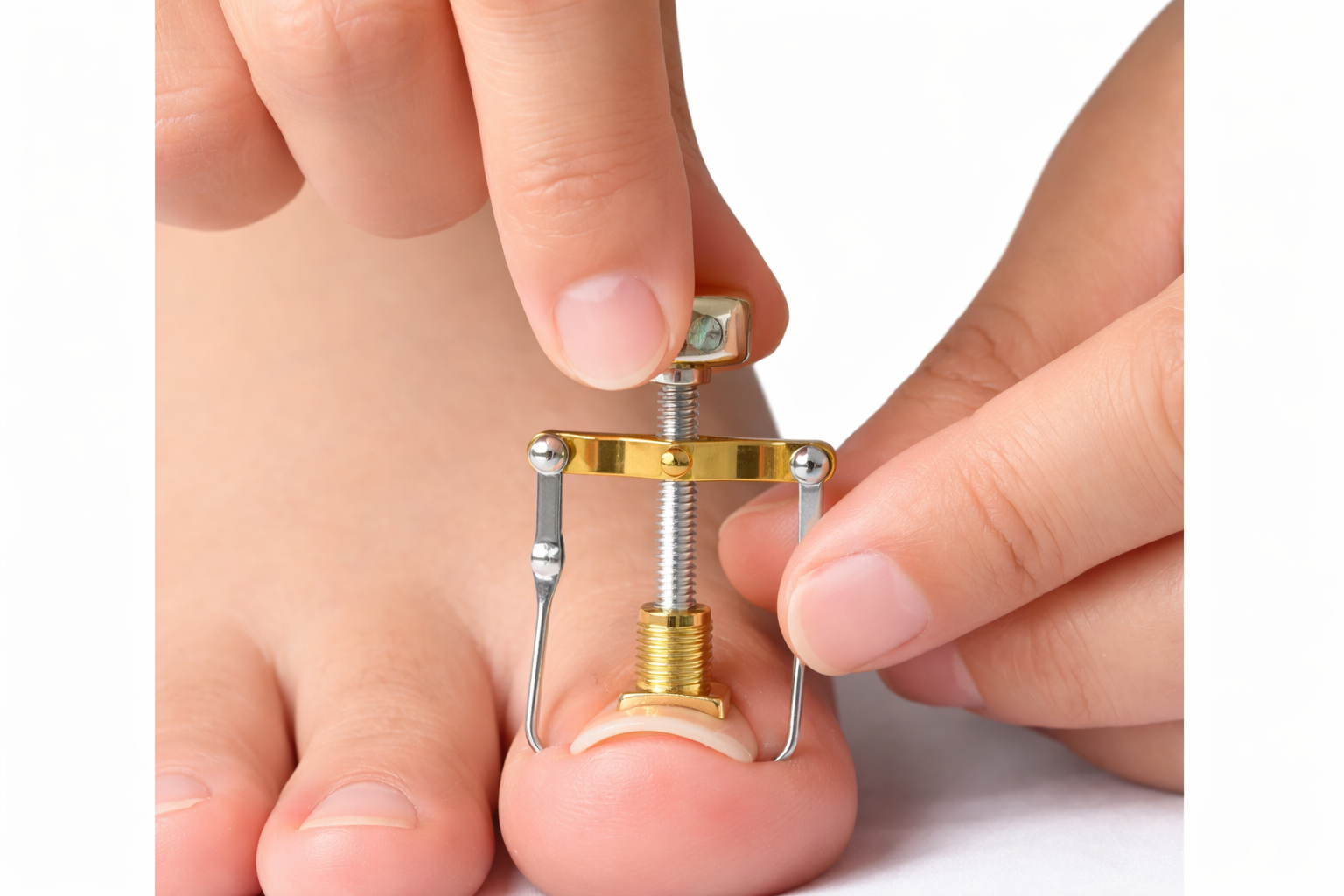 Ingrown Curved Toenail Clamp Treatment - Pōdex