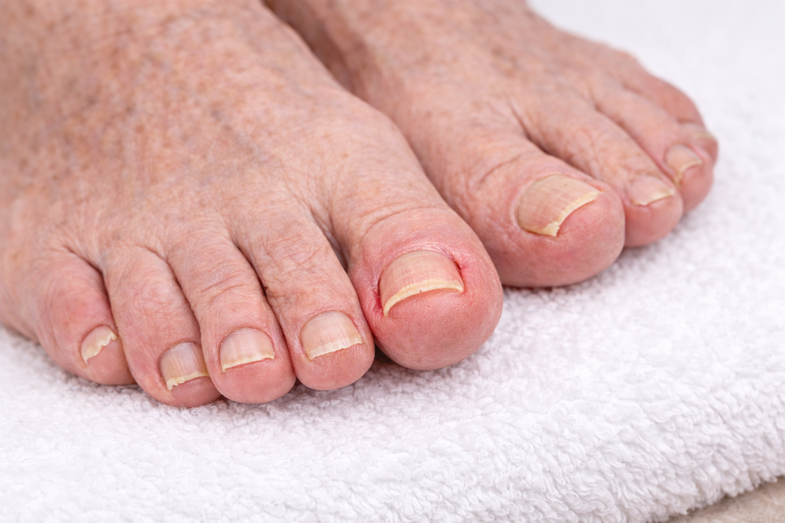 Elderly feet with thickened, slightly curved toenails showing mild ingrown toenail inflammation