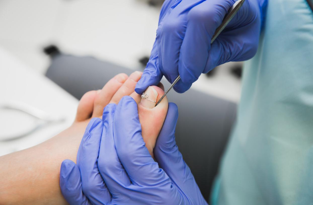 How Are Ingrown Toenails Treated? Treatment Options Explained