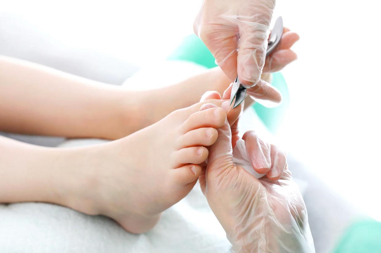 How to Cut and Care for Ingrown Toenails
